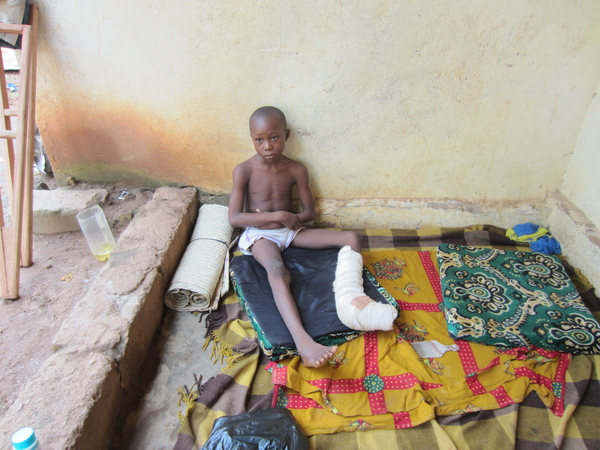 Dieudonné Pinali’s left leg was injured by a grenade planted by a Seleka soldier (Photo Credit: Godfrey Byaruhanga).
